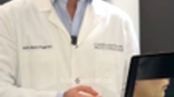 Dott. Marco Capriotti - Canova Institute Doppio mento: mini liposuzione e retrazione cutanea