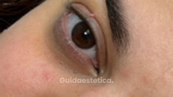 Prof. Dott. Massimiliano Giuliano Fibroma pendulo oculare