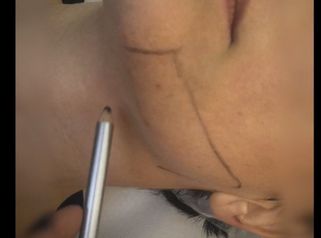 Tecnica Microbotulino x Trattamento collo