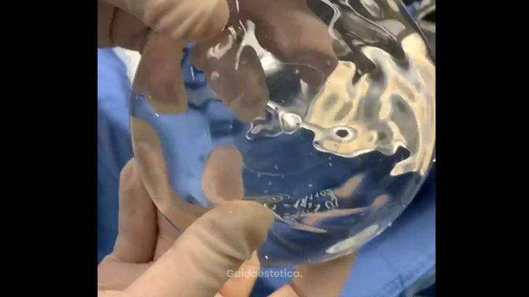 Gluteoplastica - Dott. Egidio Riggio