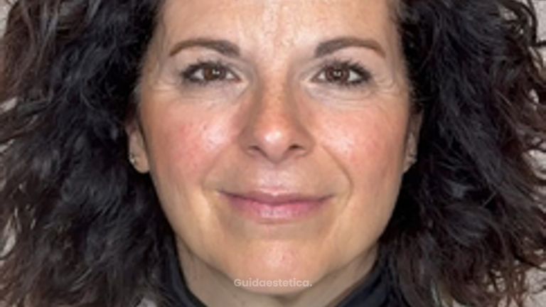 Dott.ssa Sara Carinci Botox: prima e dopo il trattamento su paziente
