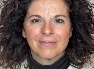 Dott.ssa Sara Carinci Botox: prima e dopo il trattamento su paziente