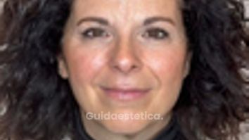 Dott.ssa Sara Carinci Botox: prima e dopo il trattamento su paziente
