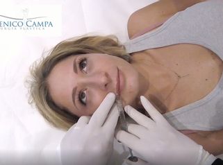 Il trattamento Filler Labbra realizzato dal Dr. Campa