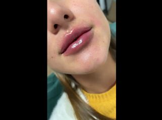 Risultato dopo il trattamento aumento labbra - Dott.ssa Ludovica Pollifrone
