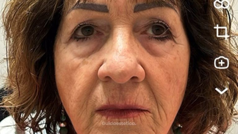 Dott.ssa Sara Carinci Full face viso
