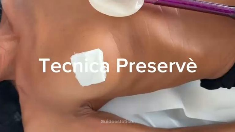 Dottori Paolo & Nicola Pittoni Tecnica Preservè per aumento non invasivo del seno