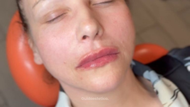 Dott.ssa Sara Carinci Risultato dopo filler labbra: esperienza di una paziente