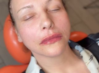 Dott.ssa Sara Carinci Risultato dopo filler labbra: esperienza di una paziente