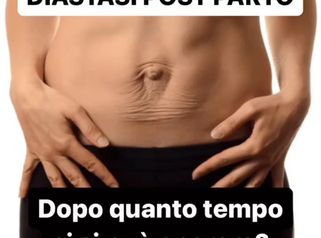 Diastasi parto - Dr Antonio Tambuscio