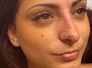 Dott. Benoit Menye Filler labbra: aumento e definizione naturale