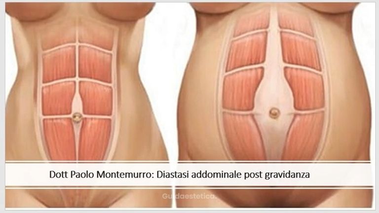 Diastasi addominale post gravidanza