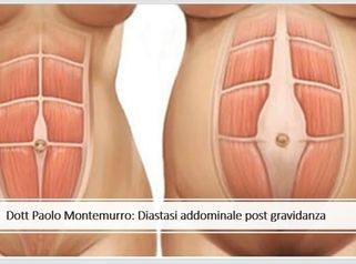 Diastasi addominale post gravidanza