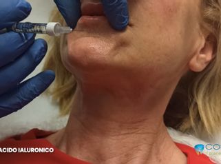 Filler acido ialuronico labbra - Poliambulatorio Cosmer Torino