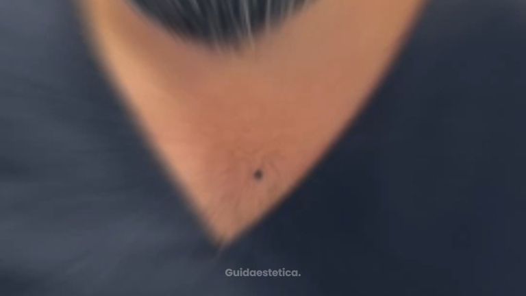 Dott. Antonio Vernillo Tina: esperienza nei primi giorni dopo la sua mastoplastica additiva.