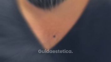Dott. Antonio Vernillo Tina: esperienza nei primi giorni dopo la sua mastoplastica additiva.