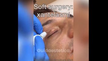 Xantelasmi - Studio medico BiospheraMed