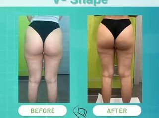 Dott. Umberto Tozzi V-Shape