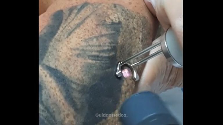 Rimozione tatuaggi - Studio medico Monica De Stefani
