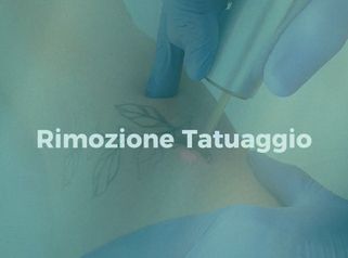 Rimozione tattoo - Clinica Deasalus - Dir. Sanitario Prof. Giorgio Maullu
