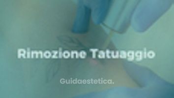 Rimozione tattoo - Clinica Deasalus - Dir. Sanitario Prof. Giorgio Maullu