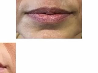 Dott. Giovanni Migliorini Filler Labbra