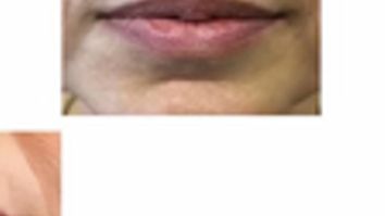 Dott. Giovanni Migliorini Filler Labbra