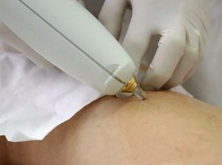 Capillari e teleangectasie, il Dott. Bettini spiega come trattarli