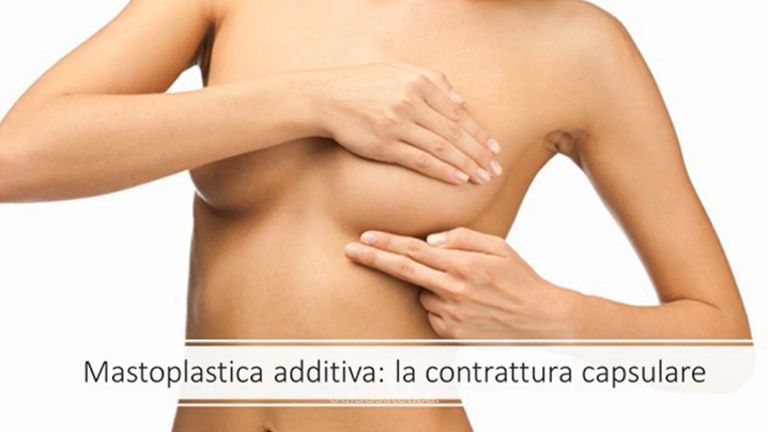 Contrattura capsulare