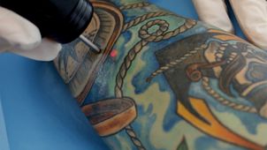 Come funziona il laser per la rimozione tatuaggi