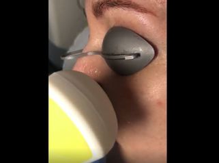 SWT Ellipse Trattamento capillari naso con la nuova tecnica della lunghezza d’onda selettiva