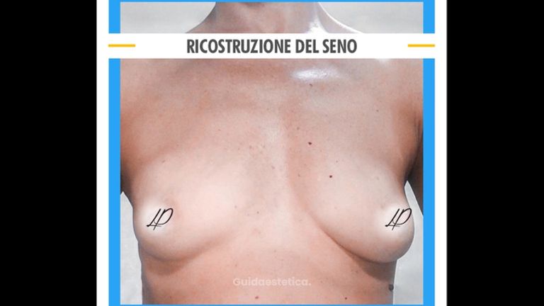 Ricostruzione seno - Dott. Pietro Loschi