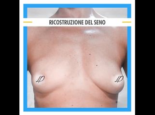 Ricostruzione seno - Dott. Pietro Loschi
