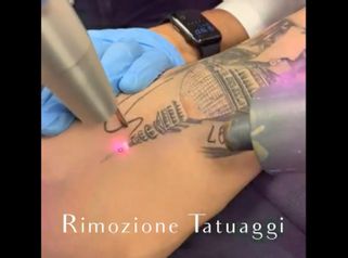 Rimozione tatuaggi - NONSOLOBISTURI