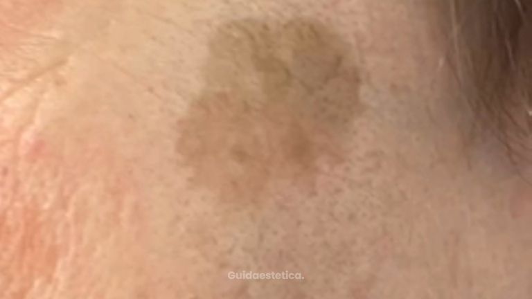 Dott.ssa Silvia Scevola Laser Q-Switched per eliminare le macchie della pelle