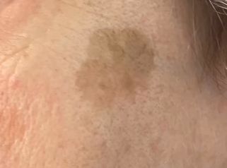 Dott.ssa Silvia Scevola Laser Q-Switched per eliminare le macchie della pelle