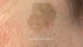 Dott.ssa Silvia Scevola Laser Q-Switched per eliminare le macchie della pelle