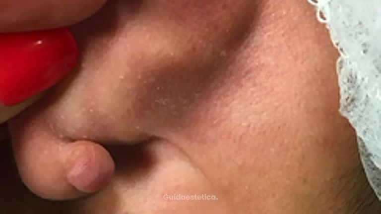 Prof. Dott. Massimiliano Giuliano Cisti lobo orecchio