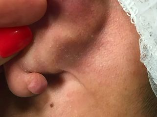 Prof. Dott. Massimiliano Giuliano Cisti lobo orecchio