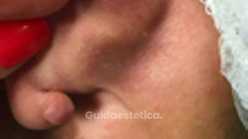 Prof. Dott. Massimiliano Giuliano Cisti lobo orecchio