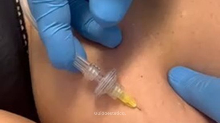 carbossiterapia Studio Medico Brenno Franceschini