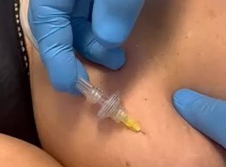 carbossiterapia Studio Medico Brenno Franceschini