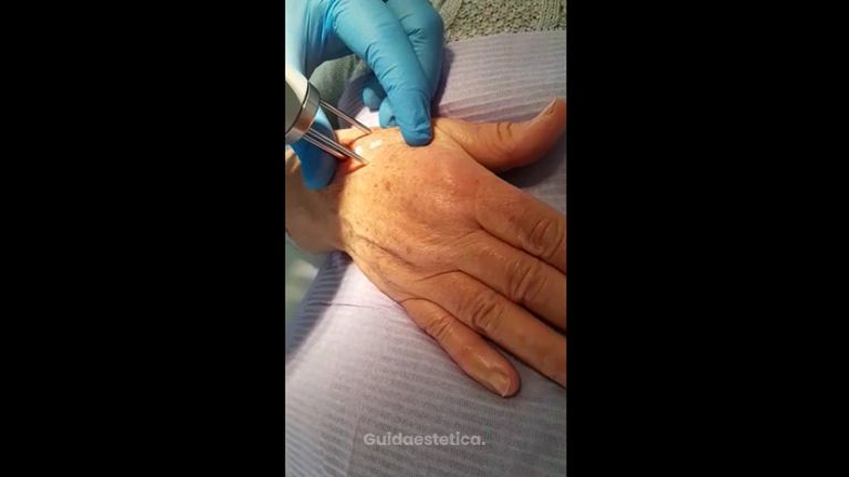Laser mani - Tuamedica