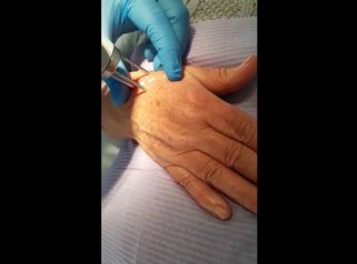 Laser mani - Tuamedica
