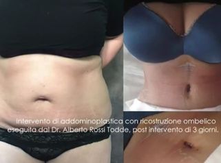 Intervento di Addominoplastica