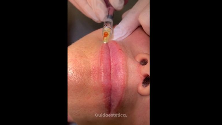 Filler labbra