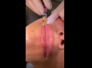 Filler labbra