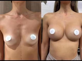 Dott. Benoit Menye Mastoplastica additiva: scelta protesi, disegno preoperatorio e risultato finale