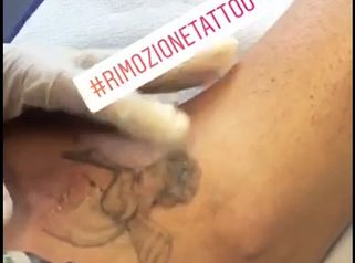 HS Care: rimozione tatuaggi