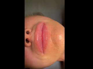 Filler labbra